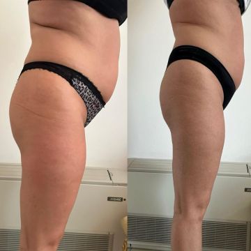 Trattamento corpo parma appiattimento pancia
