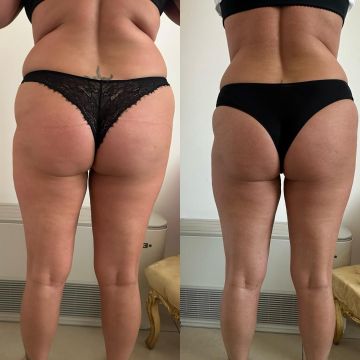 Trattamento corpo cellulite parma